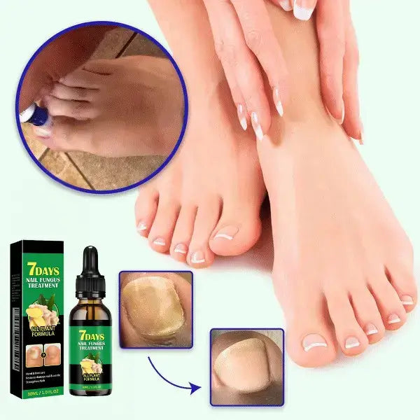 Imbirowy Płyn na Grzybicę Paznokci