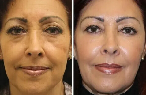Whitening & Anti-Wrinkle Serum